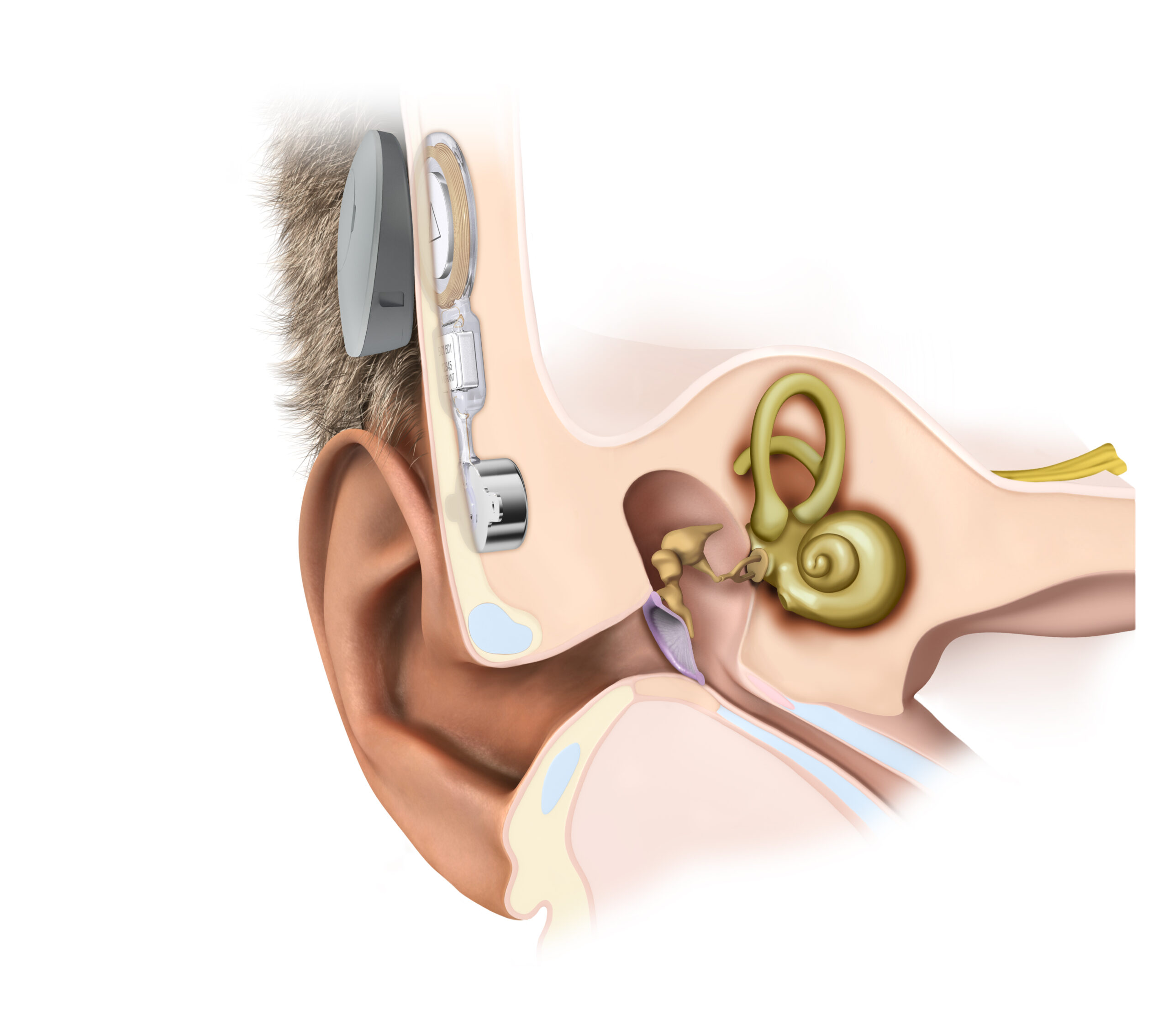 Bonebridge_SAMBA_earsection